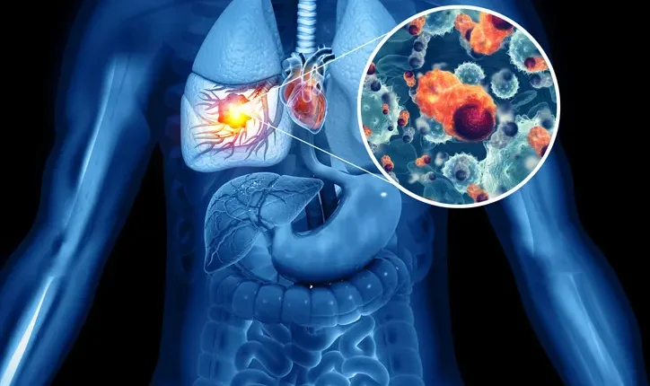 الإشعاع-يسطع-كبديل-ثوري-للجراحة-في-علاج-سرطان-الرئة-المبكر.