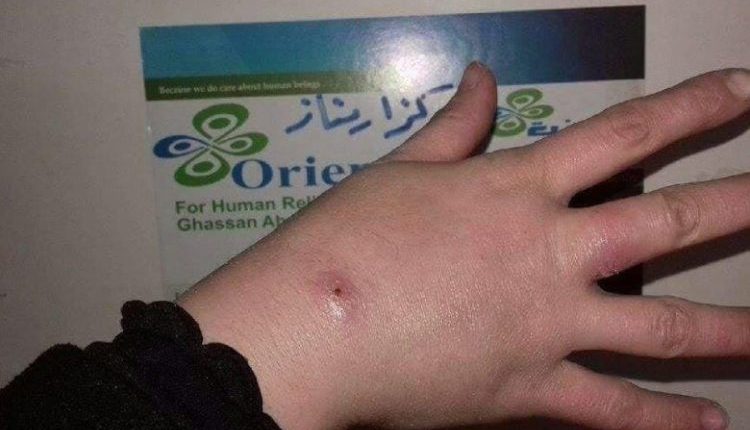 تواجه الكوادر الطبية في ريف حماة ضغوطاً متزايدة ومتسارعة نتيجة الانتشار الواسع والمستمر لمرض “اللشمانيا” (المعروف محلياً بـ حبة حلب)